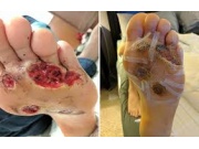 Foot comfort service corns